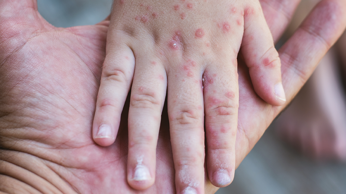 Measles: A Preventable Threat Rising Again